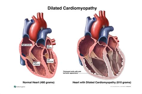 Non‐dilated left ventricular cardiomyopathy vs. dilated 